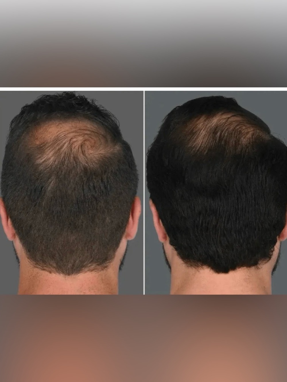Plated, new in box sealed with exosomes medical grade, unisex hair growth serum - Picture 6 of 12